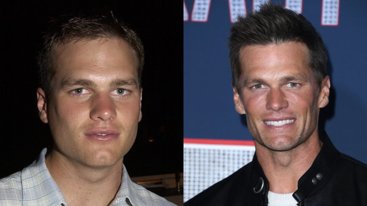 Exploring Tom Bradys Hair Transformation: Did He Really Get a Hair Transplant?