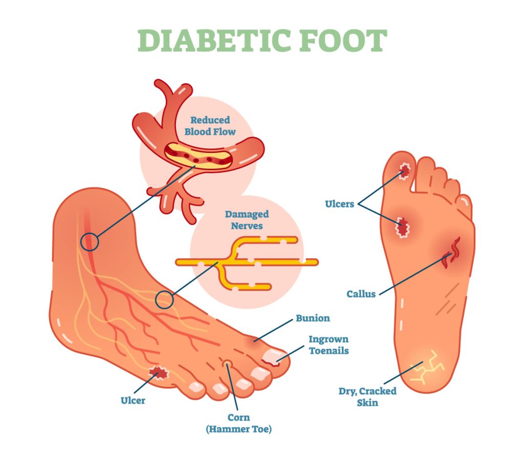 Deion Sanders Diabetes Scare: Did It Affect His Foot?