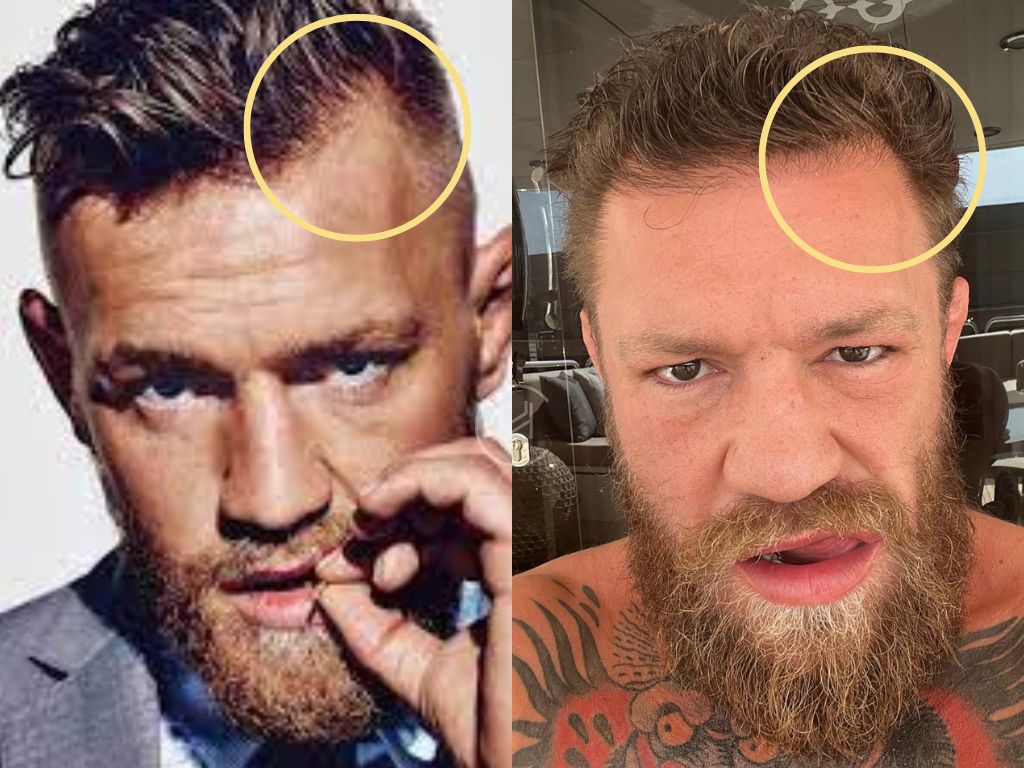 Conor McGregor Hair Loss: Exploring the Truth Behind the Rumors.